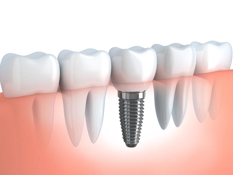 Dental Implants  Madison, WI 